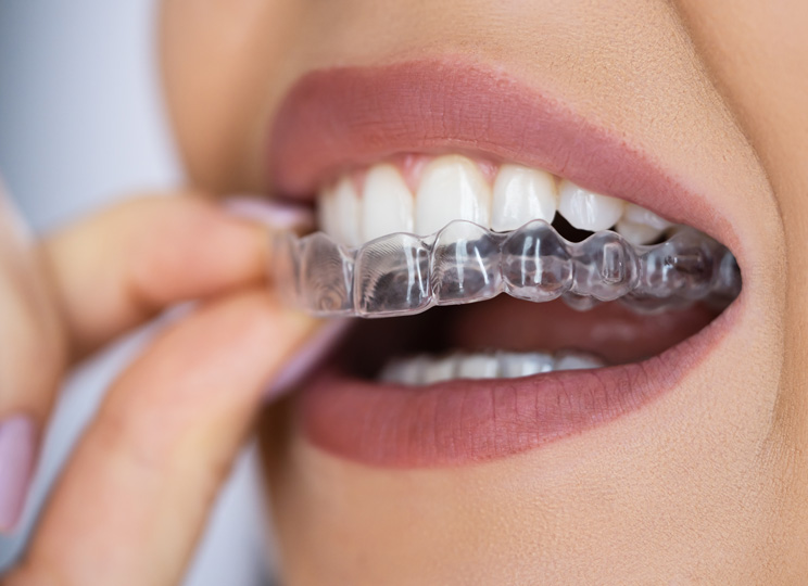 Spark aligners - a clear choice for a confident smile Spark aligners - a clear choice for a confident smile