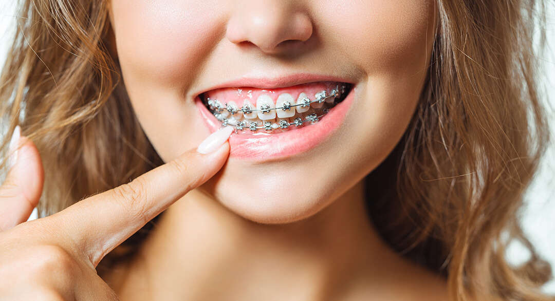 Can Braces Fix an Underbite? Options and When Jaw Surgery May Help