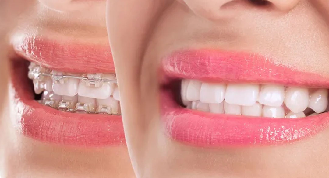 Clear Braces Vs. Clear Aligners: What’s The Difference?