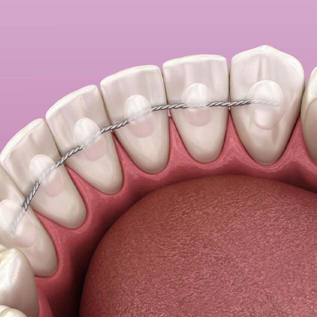 Retainers - keeping your new smile in place Retainers - keeping your new smile in place