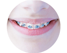 Braces types