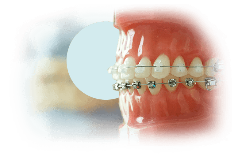 Types of braces